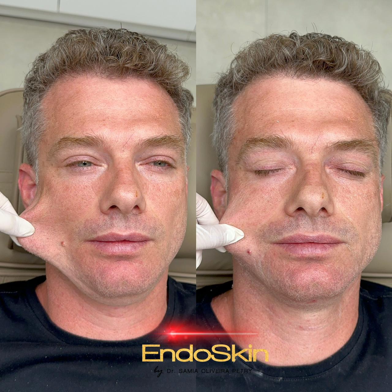 Endoskin — Instituto Neoface